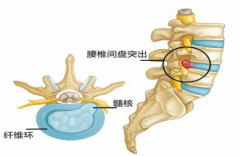 衡中医 ｜ 从从容容游刃有余，手法整复腰椎间盘突出