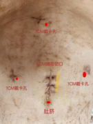 衡阳县人民医院成功开展首例腹腔镜微创肝叶切除+胆肠R-Y内引流术